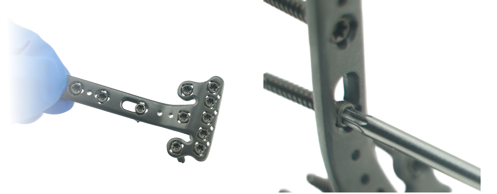 Distal Radius Volar Multi-axial Locking Plate