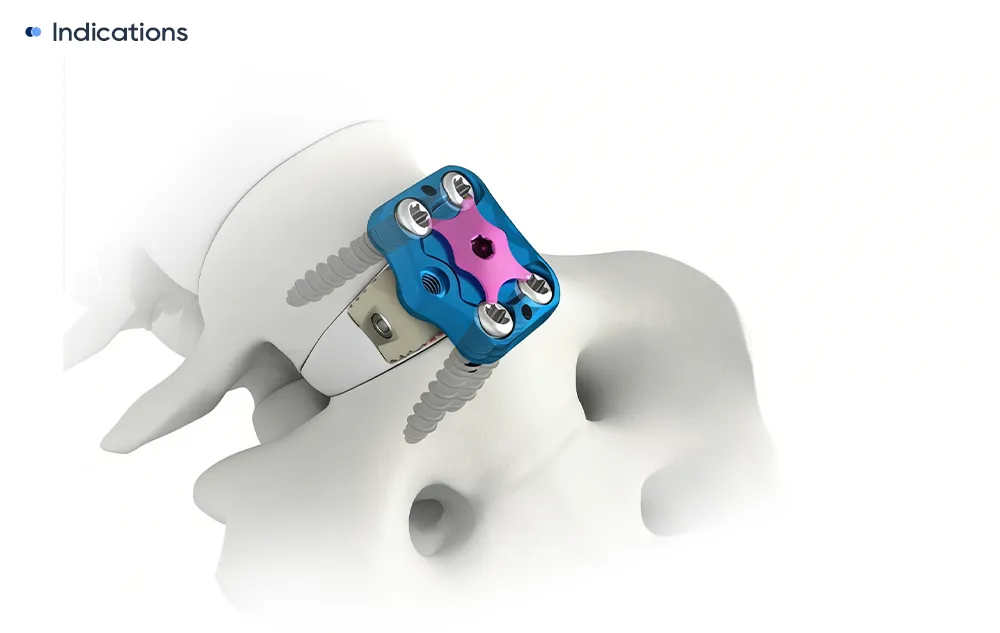Placa de fusi&oacute;n intersom&aacute;tica lumbar anterior con tornillos de bloqueo Φ5,5 implantados en un cuerpo vertebral lumbar