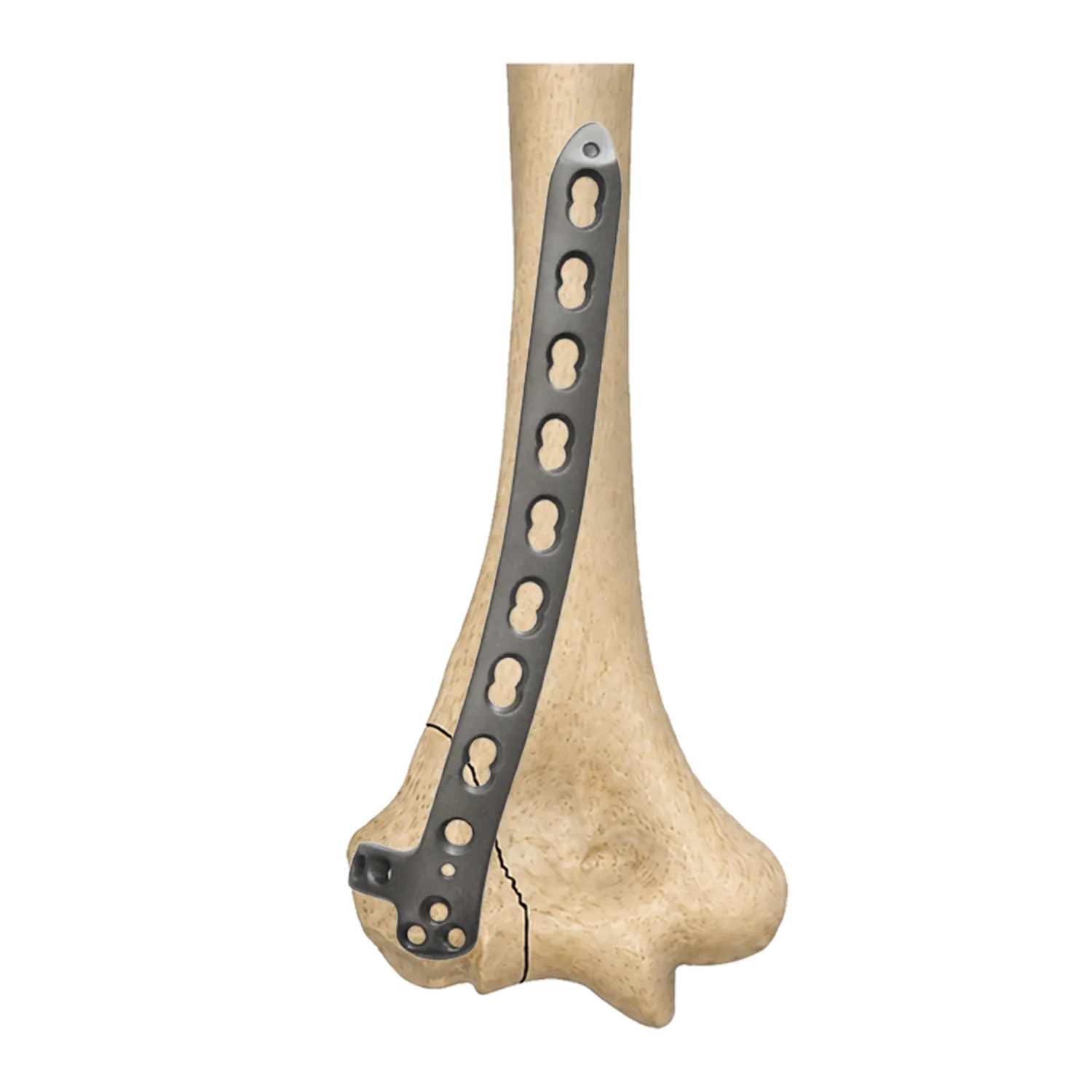 Placa de bloqueo lateral del h&uacute;mero distal fijada en un modelo de hueso del h&uacute;mero a trav&eacute;s de una fractura de columna lateral