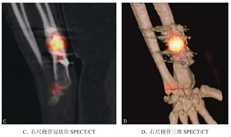 SPECT/CT representativo que muestra actividad del trazador cerca de la fractura del radio distal