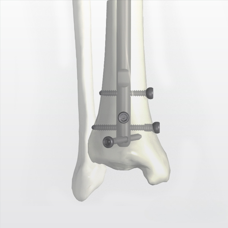 Nuevo clavo intramedular para tibia