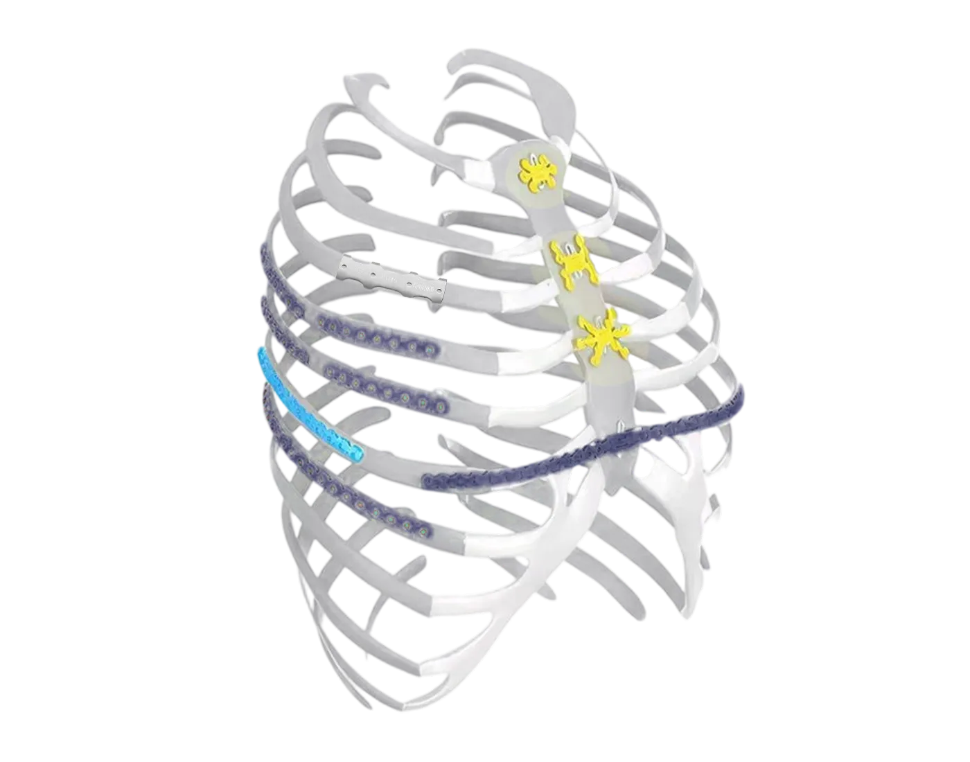 Thoracic cage with rib plate fixation system