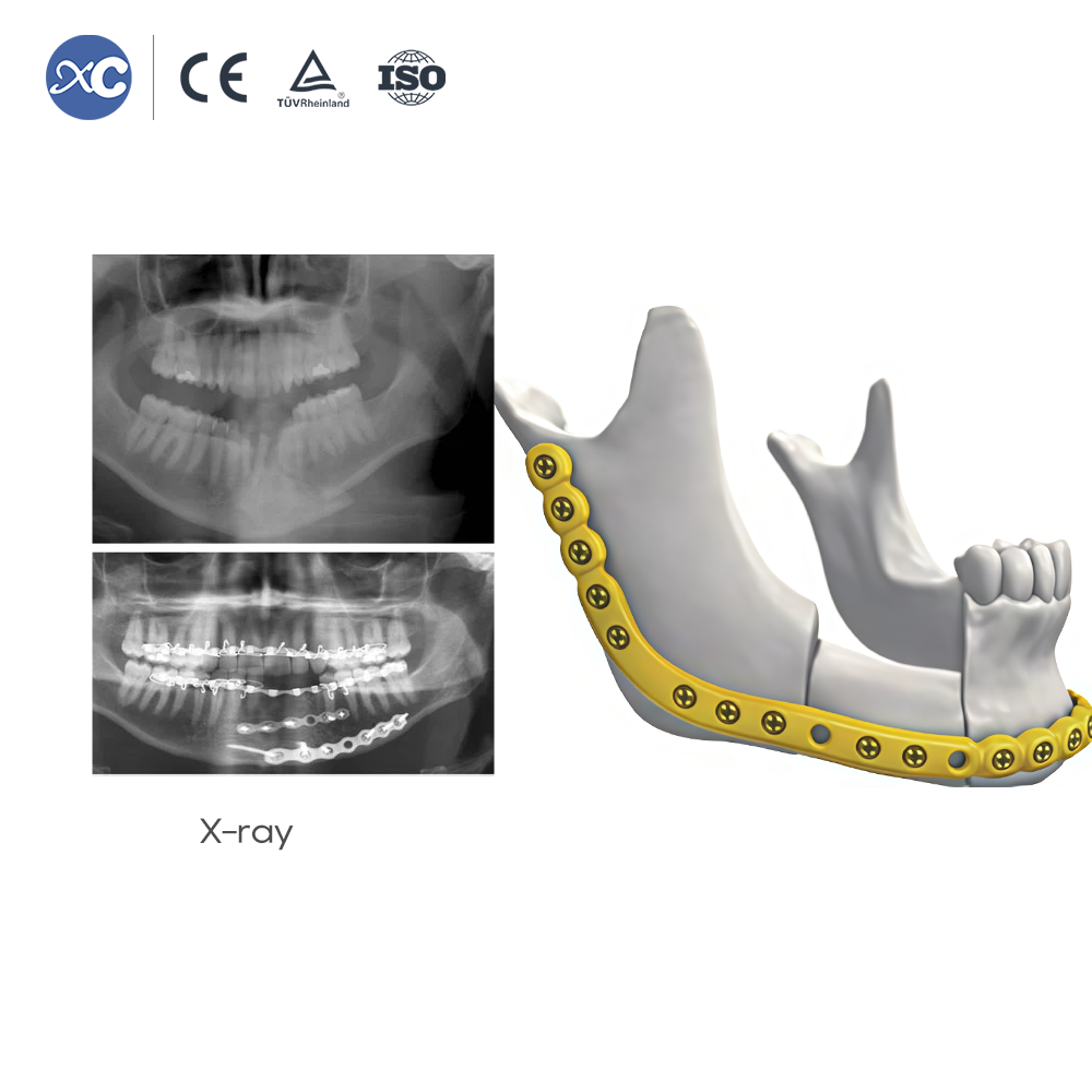 Juego de instrumentos para reconstrucción maxilofacial de 2,4 mm