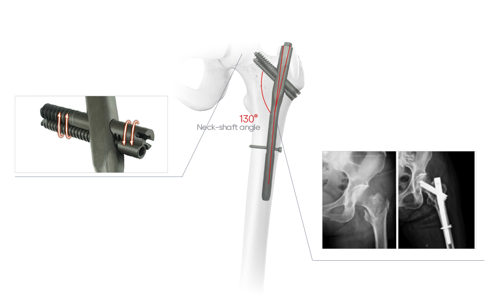 Clavo entrelazado de compresi&oacute;n, dise&ntilde;o de &aacute;ngulo lateral de 6&deg;, dise&ntilde;o estriado distal
