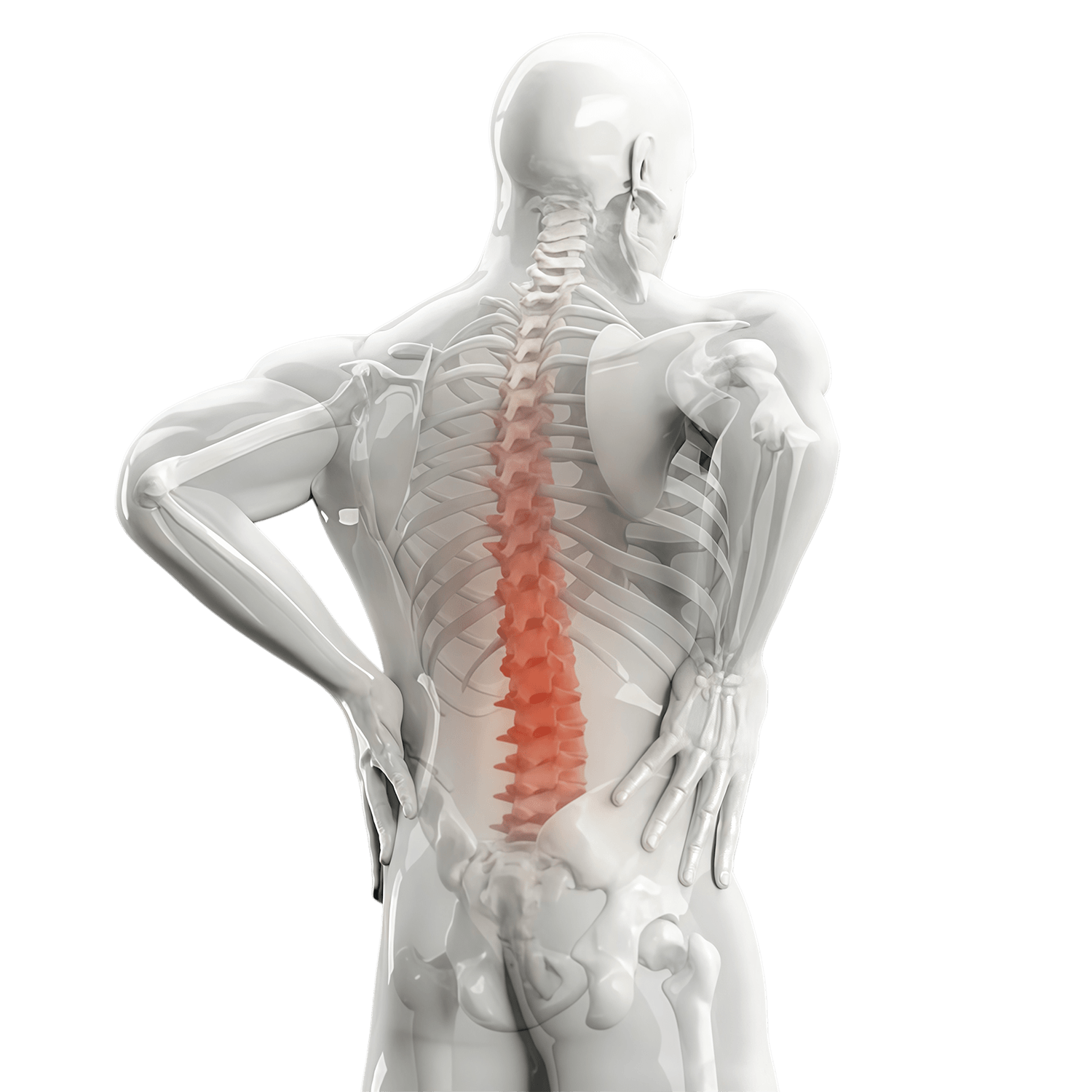 PLIF posterior lumbar interbody fusion anatomical illustration