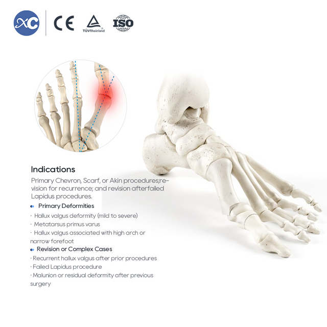 Juego de instrumentos para osteotomía MIS Hallux Valgus