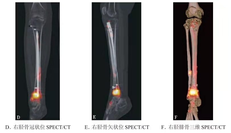 SPECT/CT representativa que muestra la actividad de la fractura de tibia/peron&eacute; y los hallazgos de la interfaz del implante