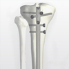 Nuevo clavo intramedular para tibia