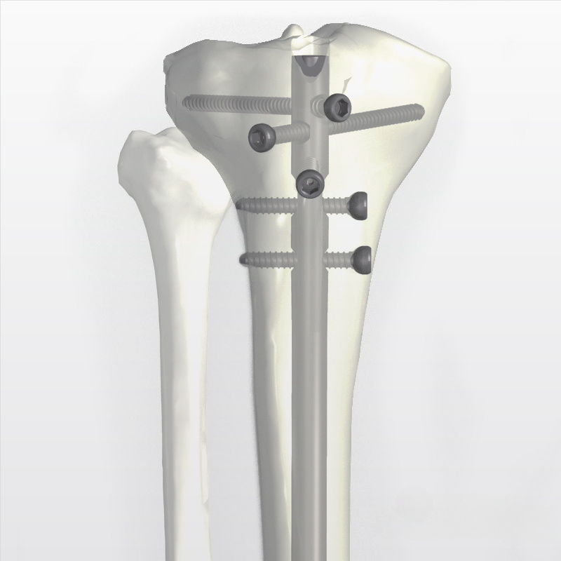 Nuevo clavo intramedular para tibia