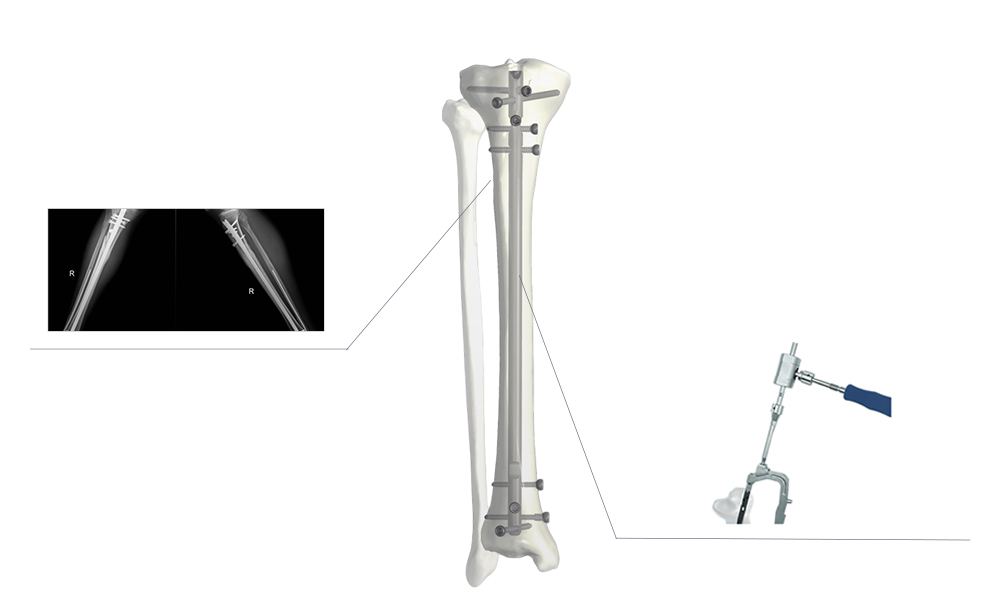 Biomec&aacute;nica del nuevo clavo intramedular de tibia