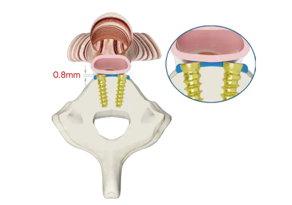 Perfil de placa cervical anterior ultrafino de 0,8 mm sobre v&eacute;rtebra cervical con tornillos de doble rosca