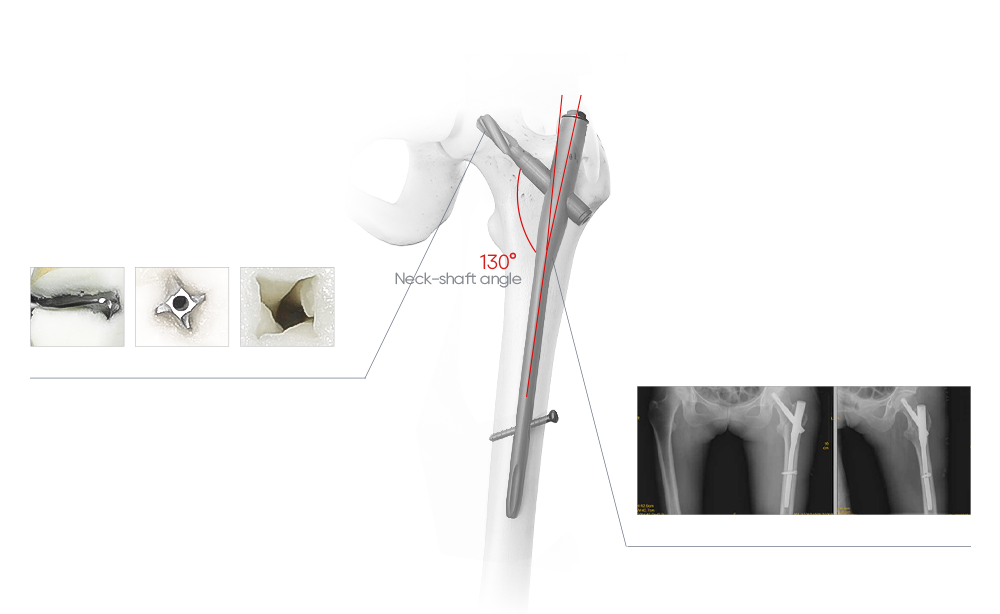Biomec&aacute;nica del clavo PFNA con hoja helicoidal, &aacute;ngulo del eje del cuello y &aacute;ngulo lateral