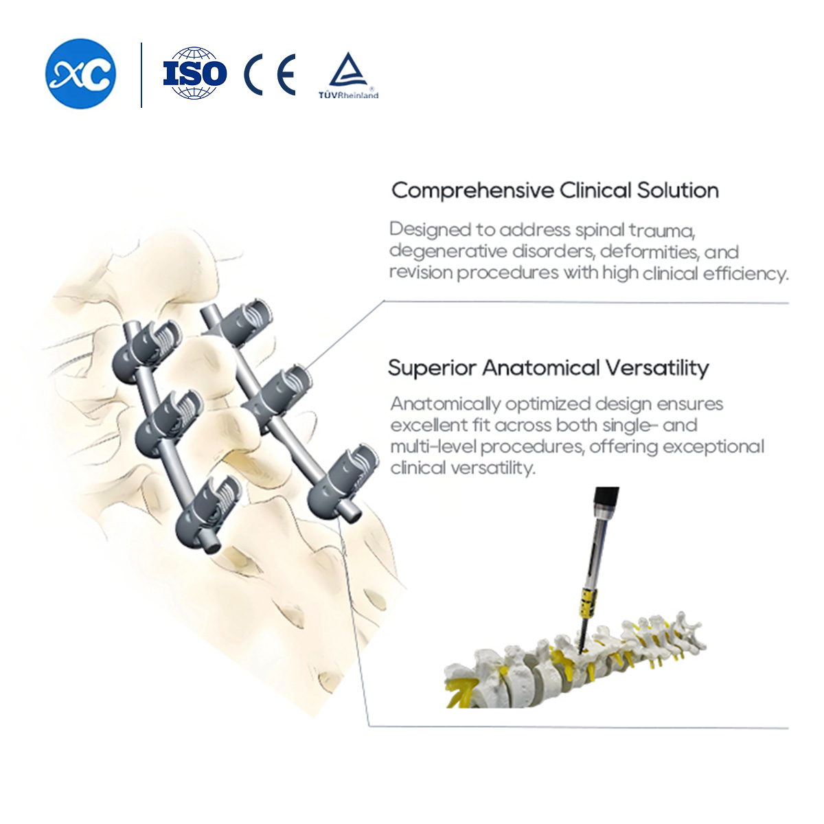 Sistema de tornillos pediculares espinales de 6,0 mm