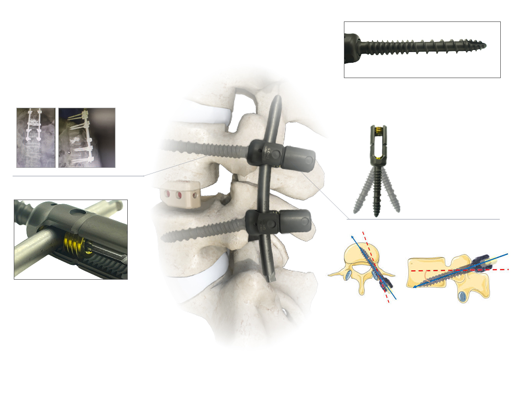 Fijaci&oacute;n lumbar estable, tornillo pedicular de doble paso, TCC frente a tornillos pediculares tradicionales