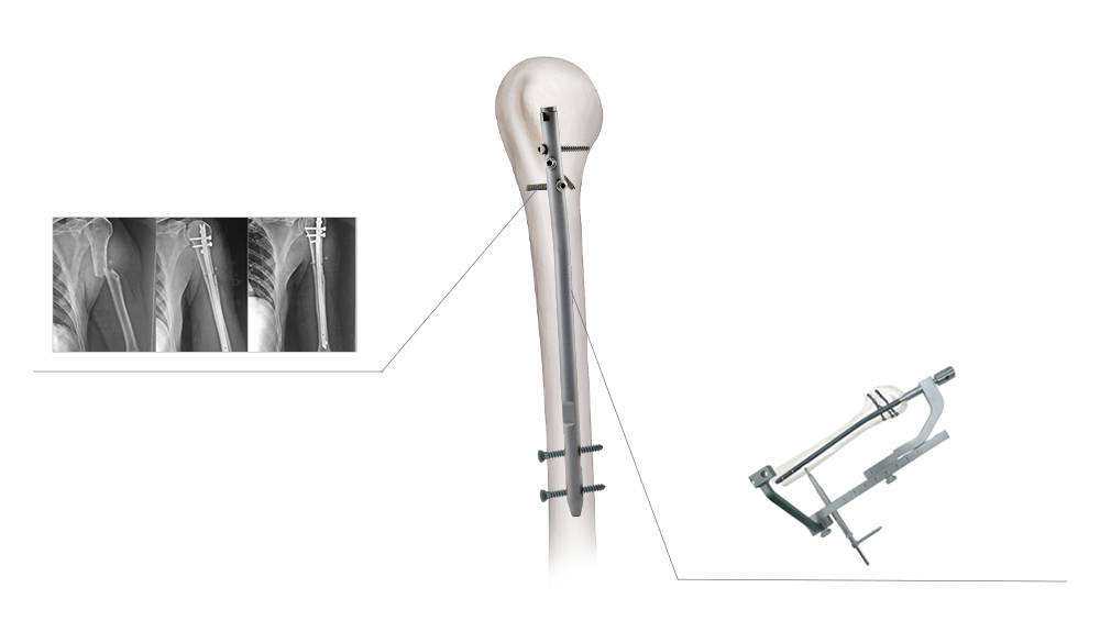 Sistema de bloqueo multiangular anat&oacute;mico y de estabilidad axial para fijaci&oacute;n humeral