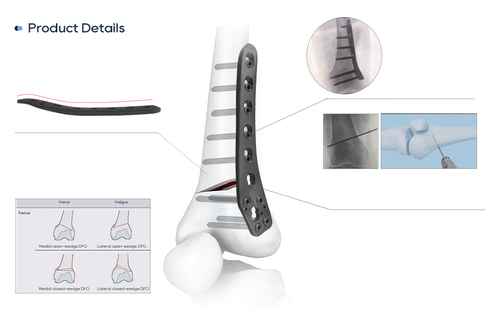 Biomec&aacute;nica de la placa de osteotom&iacute;a en cu&ntilde;a femoral distal lateral