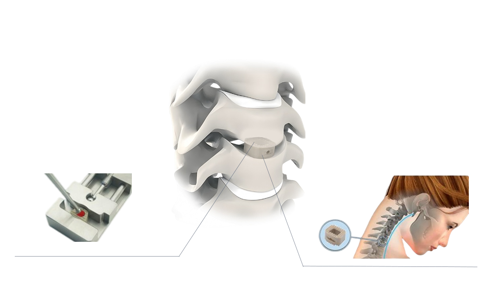 Colocaci&oacute;n biomec&aacute;nica de jaula de PEEK cervical en el segmento espinal