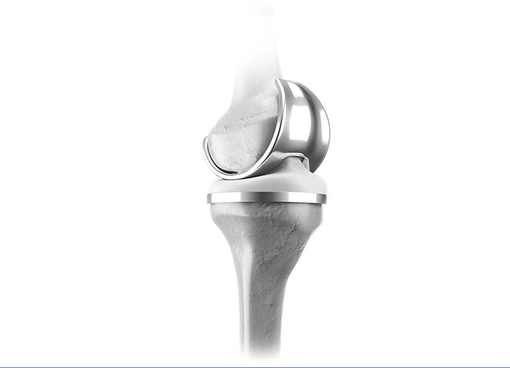 Modelo de pr&oacute;tesis de reemplazo total de rodilla con componente femoral, inserto y bandeja tibial